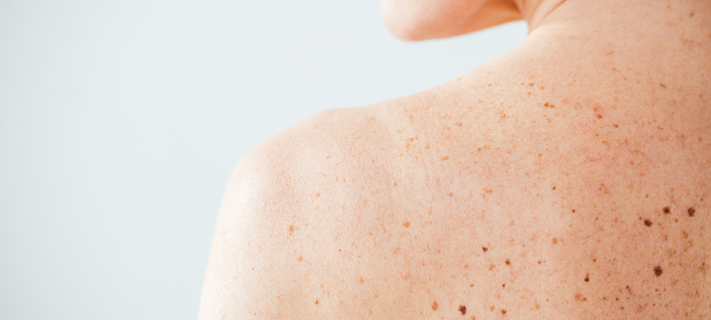 NHS embraces tech for swift dermatology consultations 