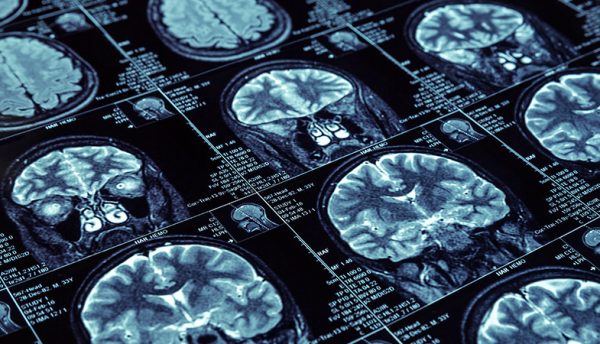Revolutionising Alzheimer’s diagnosis: Tomography advancements in blood testing for amyloid detection 