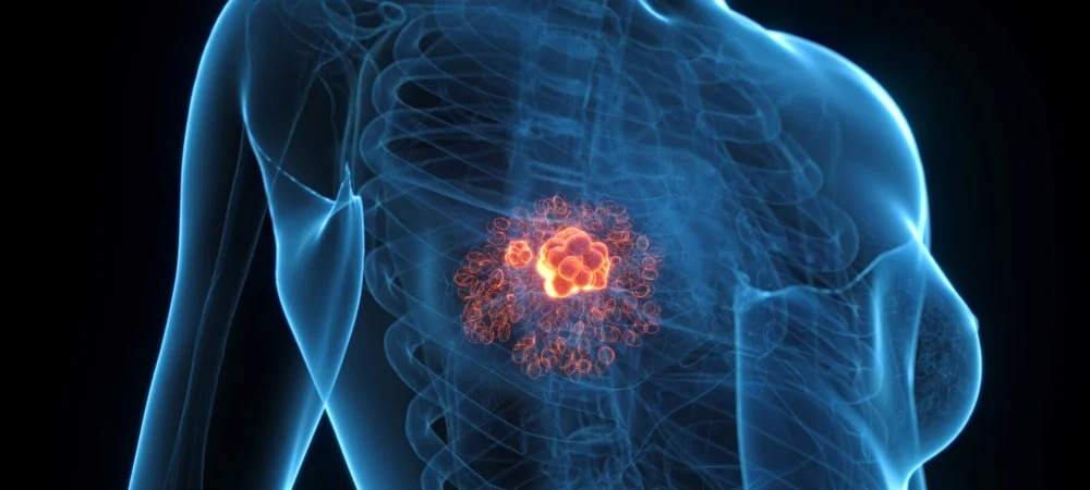 Transformative breast cancer drug approved